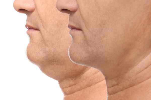 HIFU - Breakthrough in Anti - ageing 2 hifu results Westcliff-on-Sea