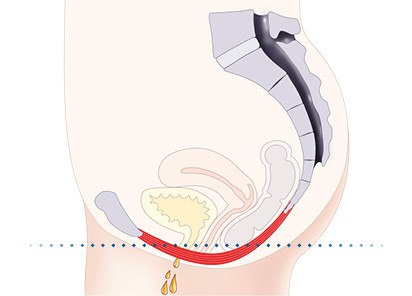 Pelvic-Floor Muscle Repair 5 Pelvic floor muscles Westcliff-on-Sea