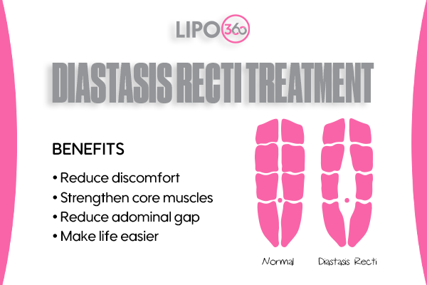 Revolutionising Muscle Repair: The Power of LIPO360 Body Sculpt Post-Injury 5 diastasis recti treatment Westcliff-on-Sea