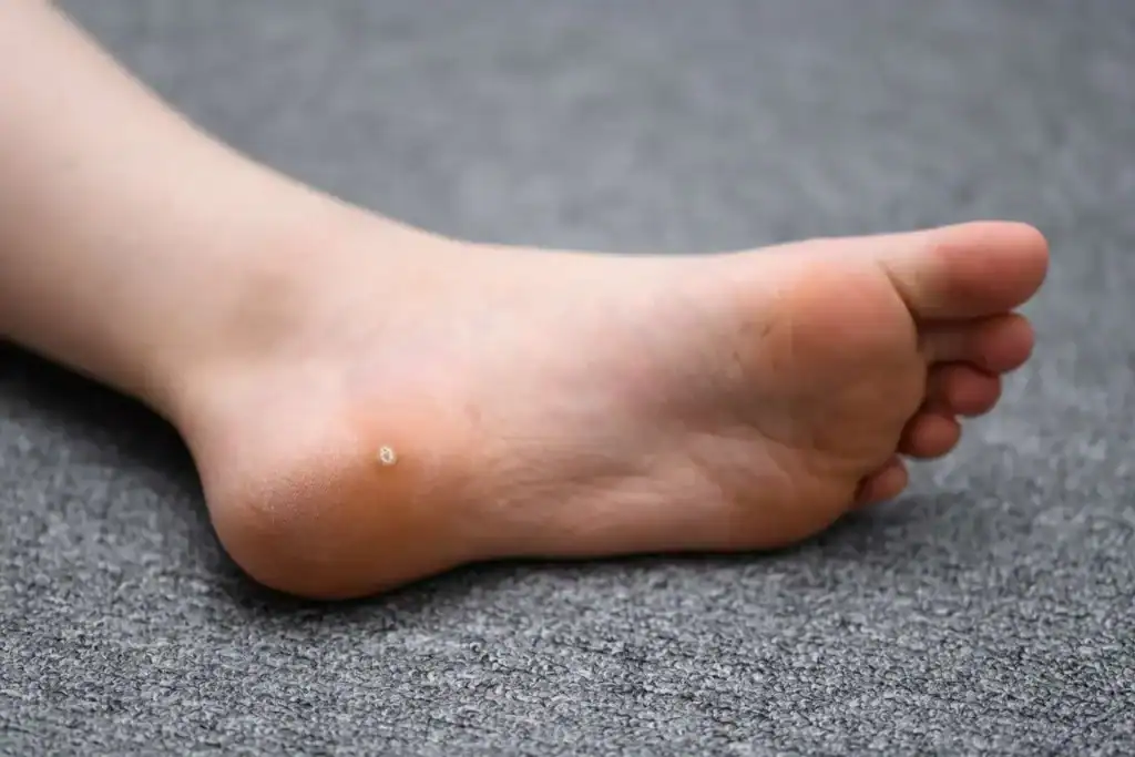 Cryotherapy For Warts And Also Verrucas 2 Image of verruca on the bottom of the foot that able to be treated with Cryotherapy Westcliff-on-Sea