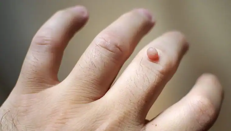 Cryotherapy For Warts And Also Verrucas 1 Image of blemish that Cryotherapy Westcliff-on-Sea can remove with Lipo 360.