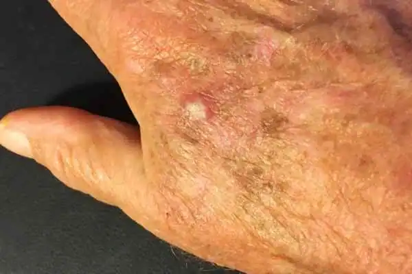 Image of Actinic keratoses Westcliff-on-Sea on a person hand
