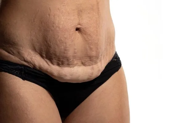 The Science of Skin Tightening 1 The science behind skin tightening Westcliff-on-Sea picture of a woman's sagging skin on the stomach